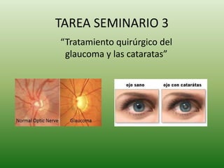 TAREA SEMINARIO 3
“Tratamiento quirúrgico del
glaucoma y las cataratas”
 