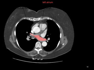 RADIOTHERAPY TARGET DELINEATION IN BREAST CANCER | PPTX
