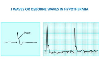 J WAVES OR OSBORNE WAVES IN HYPOTHERMIA
 