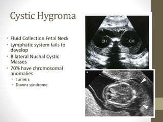 Cystic Hygroma
• Fluid Collection Fetal Neck
• Lymphatic system fails to
develop
• Bilateral Nuchal Cystic
Masses
• 70% have chromosomal
anomalies
• Turners
• Downs syndrome
 