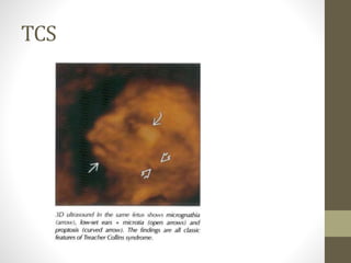 TCS
 