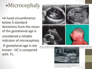•Microcephaly
•A head circumference
below 3 standard
deviations from the mean
of the gestational age is
considered a reliable
indicator of microcephaly.
IF gestational age is not
known .HC is compared
with FL.
 