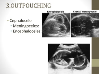 3.OUTPOUCHING
• Cephalocele
• Meningoceles:
• Encephaloceles:
 