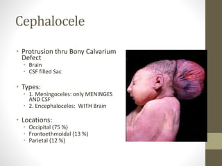 Cephalocele
• Protrusion thru Bony Calvarium
Defect
• Brain
• CSF filled Sac
• Types:
• 1. Meningoceles: only MENINGES
AND CSF
• 2. Encephaloceles: WITH Brain
• Locations:
• Occipital (75 %)
• Frontoethmoidal (13 %)
• Parietal (12 %)
 