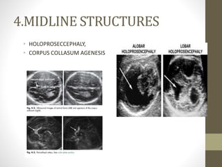 4.MIDLINE STRUCTURES
• HOLOPROSECCEPHALY,
• CORPUS COLLASUM AGENESIS
 