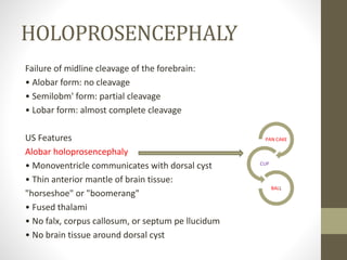 HOLOPROSENCEPHALY
Failure of midline cleavage of the forebrain:
• Alobar form: no cleavage
• Semilobm' form: partial cleavage
• Lobar form: almost complete cleavage
US Features
Alobar holoprosencephaly
• Monoventricle communicates with dorsal cyst
• Thin anterior mantle of brain tissue:
"horseshoe" or "boomerang"
• Fused thalami
• No falx, corpus callosum, or septum pe llucidum
• No brain tissue around dorsal cyst
PAN CAKE
CUP
BALL
 