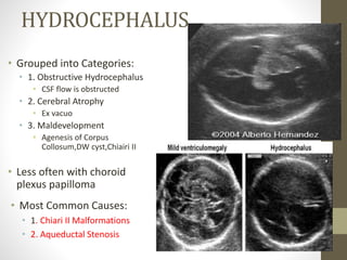 HYDROCEPHALUS
• Grouped into Categories:
• 1. Obstructive Hydrocephalus
• CSF flow is obstructed
• 2. Cerebral Atrophy
• Ex vacuo
• 3. Maldevelopment
• Agenesis of Corpus
Collosum,DW cyst,Chiairi II
• Less often with choroid
plexus papilloma
• Most Common Causes:
• 1. Chiari II Malformations
• 2. Aqueductal Stenosis
 