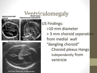 Ventriculomegaly
US Findings:
>10 mm diameter
> 3 mm choroid seperation
from medial wall
“dangling choroid”
Choroid plexus Hangs
independently from
ventricle
 