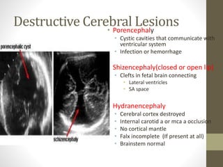 Destructive Cerebral Lesions• Porencephaly
• Cystic cavities that communicate with
ventricular system
• Infection or hemorrhage
• Shizencephaly(closed or open lip)
• Clefts in fetal brain connecting
• Lateral ventricles
• SA space
• Hydranencephaly
• Cerebral cortex destroyed
• Internal carotid a or mca a occlusion
• No cortical mantle
• Falx incomplete (If present at all)
• Brainstem normal
 