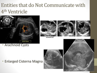 Entities that do Not Communicate with
4th Ventricle
• Arachnoid Cysts
• Enlarged Cisterna Magna
 