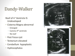 Dandy-Walker
Roof of 4 t Ventricle IS
Undeveloped
• Cisterna Magna abnormal
• Enlarged
• Comms 4th ventricle
• No roof
• Post Fossa cyst
• Tentorium elevated
• Cerebellum hypoplastic
• Hydrocephalus
 