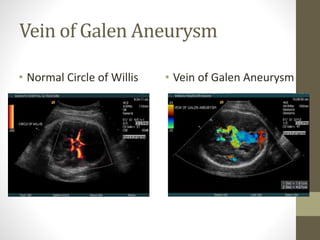 Vein of Galen Aneurysm
• Normal Circle of Willis • Vein of Galen Aneurysm
 