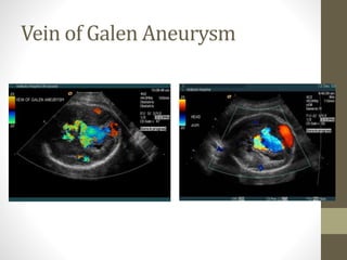 Vein of Galen Aneurysm
 