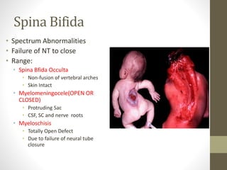 Spina Bifida
• Spectrum Abnormalities
• Failure of NT to close
• Range:
• Spina Bfida Occulta
• Non-fusion of vertebral arches
• Skin Intact
• Myelomeningocele(OPEN OR
CLOSED)
• Protruding Sac
• CSF, SC and nerve roots
• Myeloschisis
• Totally Open Defect
• Due to failure of neural tube
closure
 