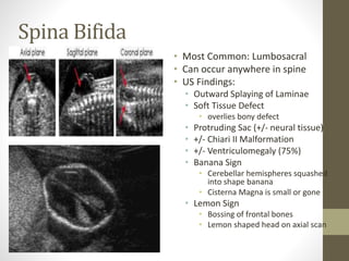 Spina Bifida
• Most Common: Lumbosacral
• Can occur anywhere in spine
• US Findings:
• Outward Splaying of Laminae
• Soft Tissue Defect
• overlies bony defect
• Protruding Sac (+/- neural tissue)
• +/- Chiari II Malformation
• +/- Ventriculomegaly (75%)
• Banana Sign
• Cerebellar hemispheres squashed
into shape banana
• Cisterna Magna is small or gone
• Lemon Sign
• Bossing of frontal bones
• Lemon shaped head on axial scan
 