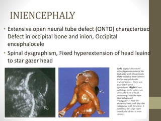 INIENCEPHALY
• Extensive open neural tube defect (ONTD) characterized
Defect in occipital bone and inion, Occipital
encephalocele
• Spinal dysgraphism, Fixed hyperextension of head leaind
to star gazer head
 
