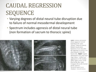 CAUDAL REGRESSION
SEQUENCE
• Varying degrees of distal neural tube disruption due
to failure of normal mesodermal development
• Spectrum includes agenesis of distal neural tube
(non formation of sacrum to thoracic spine)
 