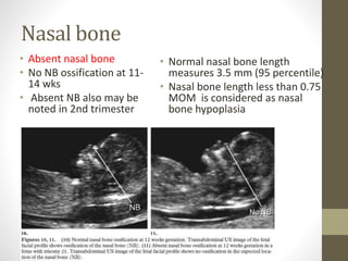 Nasal bone
• Absent nasal bone
• No NB ossification at 11-
14 wks
• Absent NB also may be
noted in 2nd trimester
• Normal nasal bone length
measures 3.5 mm (95 percentile)
• Nasal bone length less than 0.75
MOM is considered as nasal
bone hypoplasia
 