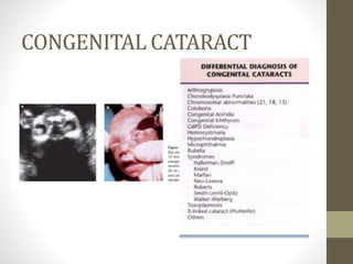 CONGENITAL CATARACT
 