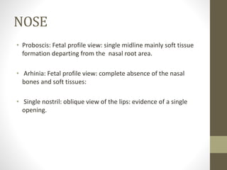 NOSE
• Proboscis: Fetal profile view: single midline mainly soft tissue
formation departing from the nasal root area.
• Arhinia: Fetal profile view: complete absence of the nasal
bones and soft tissues:
• Single nostril: oblique view of the lips: evidence of a single
opening.
 
