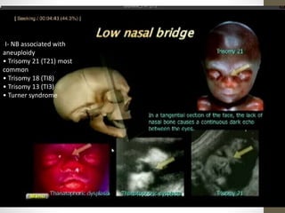 -I- NB associated with
aneuploidy
• Trisomy 21 (T21) most
common
• Trisomy 18 (TI8)
• Trisomy 13 (TI3)
• Turner syndrome
 