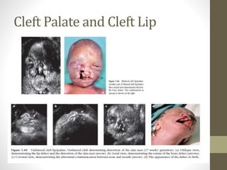Cleft Palate and Cleft Lip
 