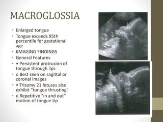 MACROGLOSSIA
• Enlarged tongue
• Tongue exceeds 95th
percentile for gestational
age
• IIMAGING FINDINGS
• General Features
• • Persistent protrusion of
tongue through lips
• o Best seen on sagittal or
coronal images
• • Trisomy 21 fetuses also
exhibit "tongue thrusting"
• o Repetitive "in and out"
motion of tongue tip
 