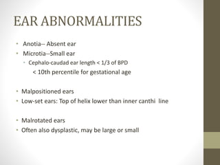 EAR ABNORMALITIES
• Anotia-- Absent ear
• Microtia--Small ear
• Cephalo-caudad ear length < 1/3 of BPD
< 10th percentile for gestational age
• Malpositioned ears
• Low-set ears: Top of helix lower than inner canthi line
• Malrotated ears
• Often also dysplastic, may be large or small
 