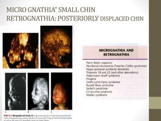 MICROGNATHIA”SMALLCHIN
RETROGNATHIA:POSTERIORLYDISPLACEDCHIN
 