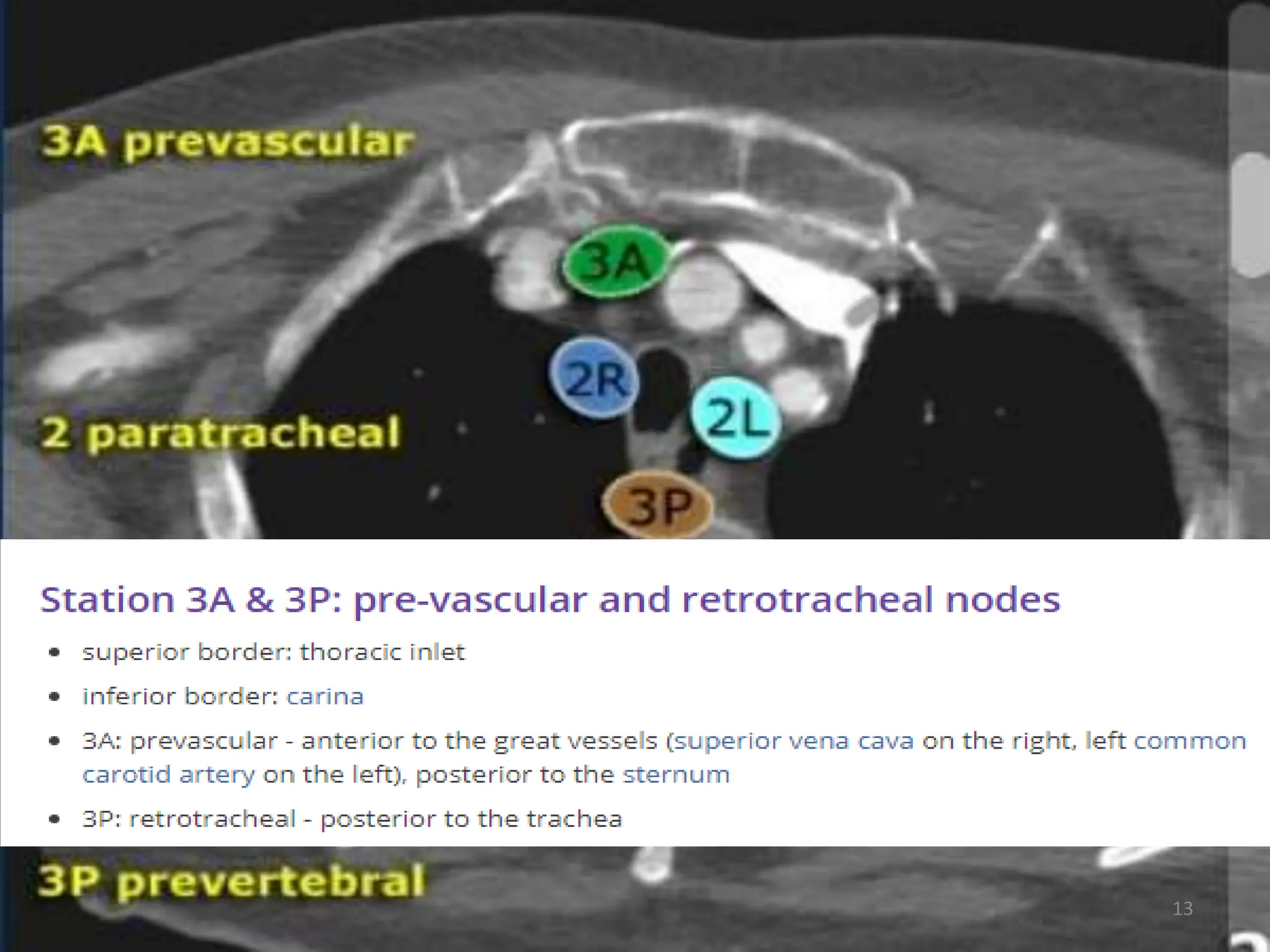 TARGET DELINEATION OF THORACIC NODAL. STATION | PPTX