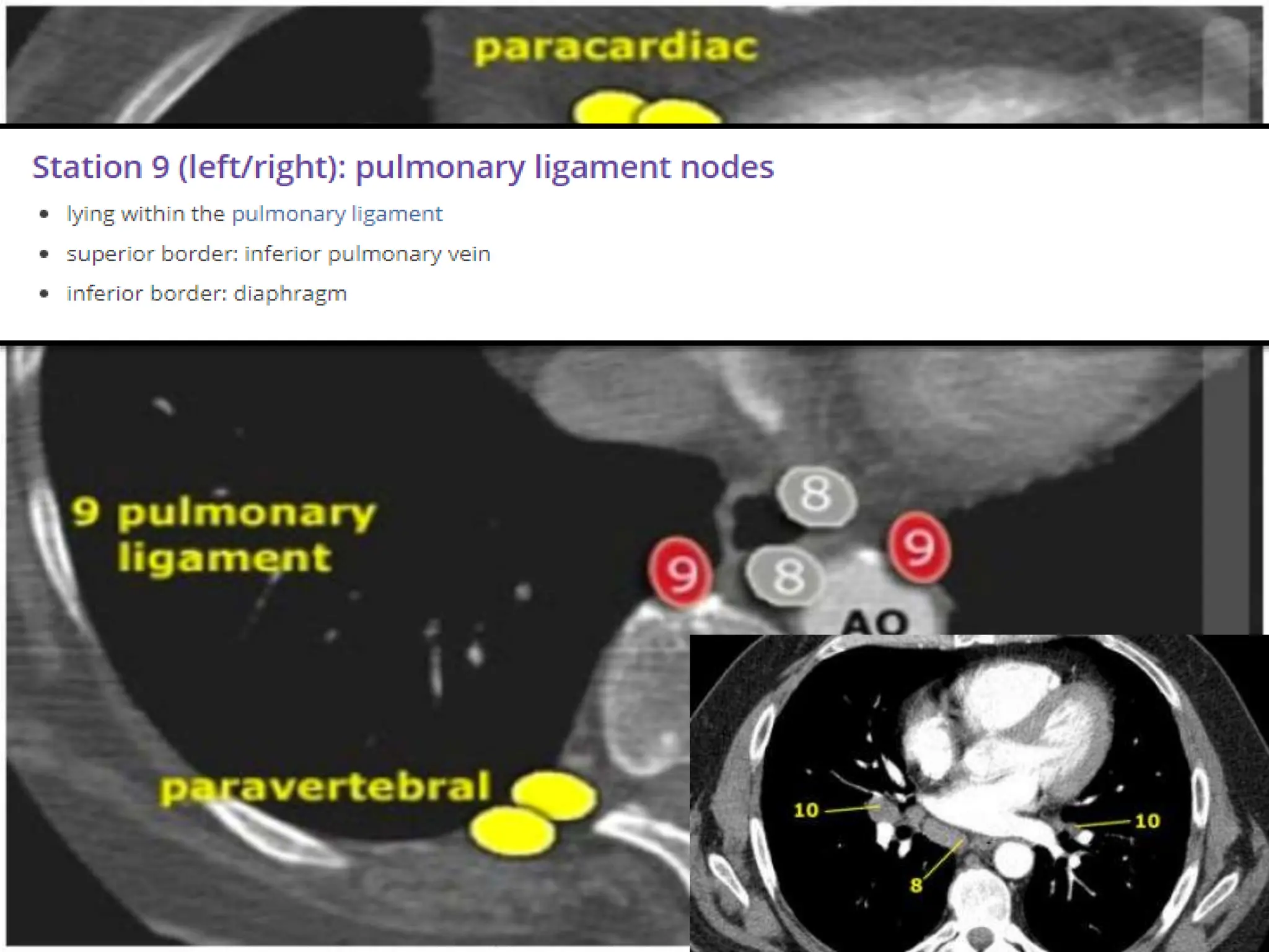 TARGET DELINEATION OF THORACIC NODAL. STATION | PPTX