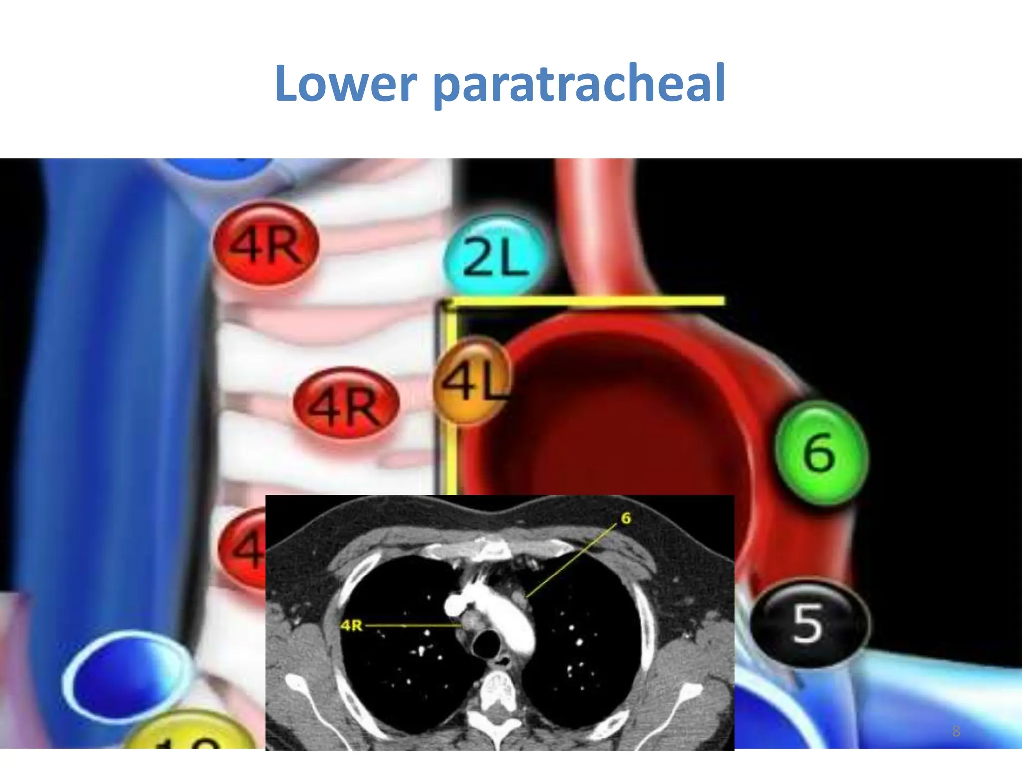 TARGET DELINEATION OF THORACIC NODAL. STATION | PPTX