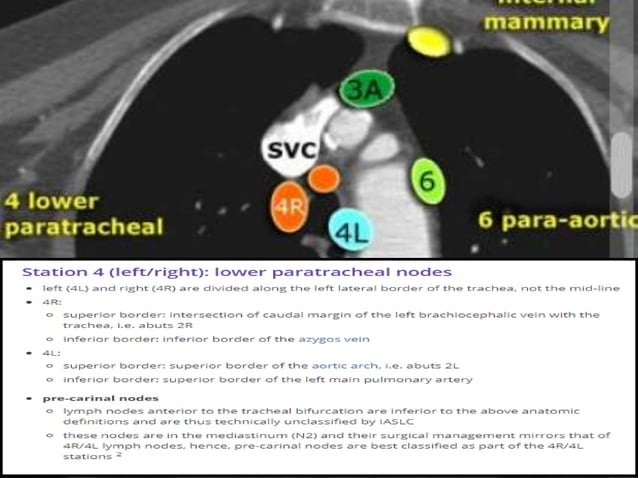 TARGET DELINEATION OF THORACIC NODAL. STATION | PPTX