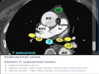 TARGET DELINEATION OF THORACIC NODAL. STATION | PPTX