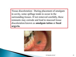 Dr Mujtaba Ashraf 43
Tissue discoloration: During placement of amalgam
in cavity, some spillage tends to occur in the
surrounding tissues. If not removed carefully, these
remnants may corrode and lead to mucosal tissue
discoloration known as amalgam tattoo or focal
argyria.
 