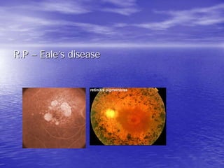 R.P – Eale’s disease
 