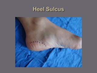 Sulcus In Foot Tarsal Tunnel Incision | PPTX