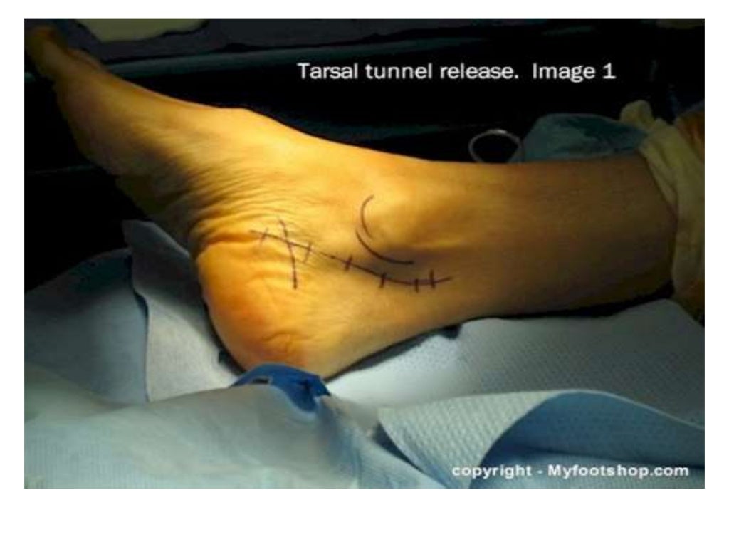Tarsal tunnel syndrome