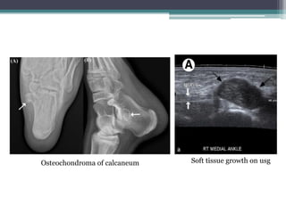 Osteochondroma of calcaneum Soft tissue growth on usg
 