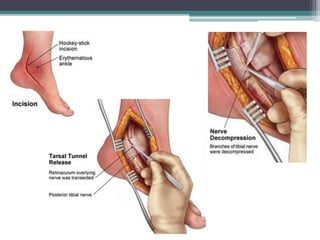 Tarsal tunnel syndrome complete review