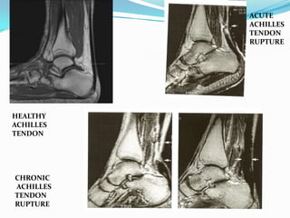 Ta Rupture Management of TendoAchillis rupture | PPTX