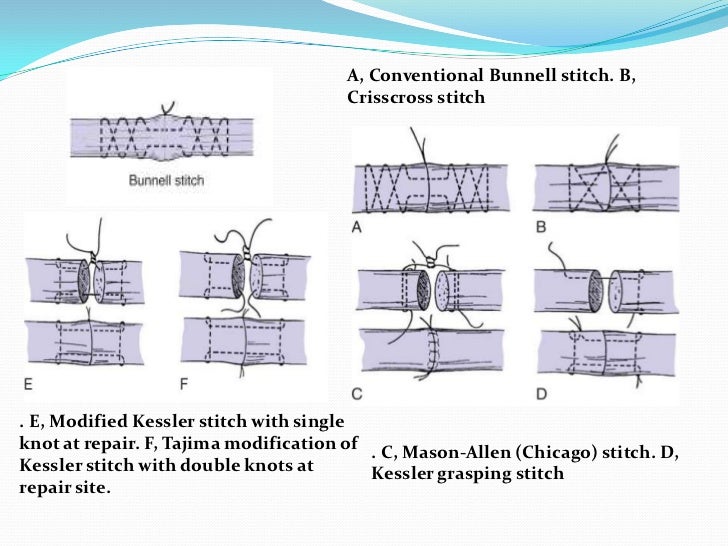 Management Of Tendoachillis Rupture