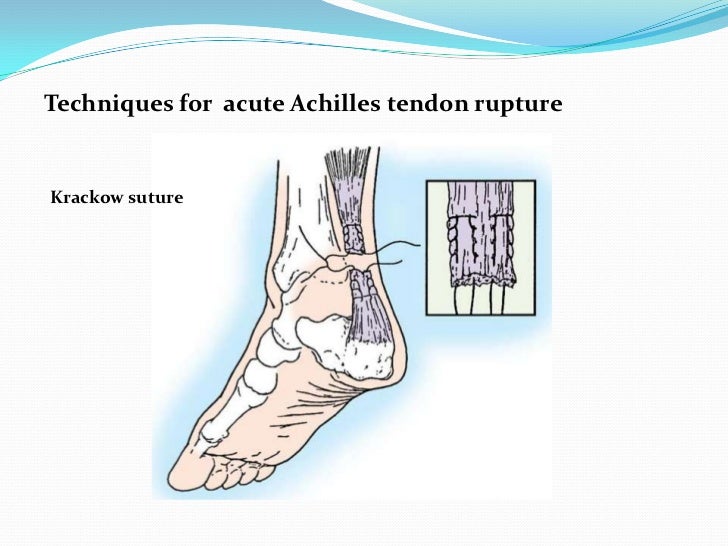 Ta Rupture achilles tendon rupture on emaze