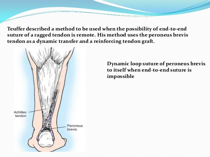 Ta Rupture achilles tendon rupture at emaze Presentation