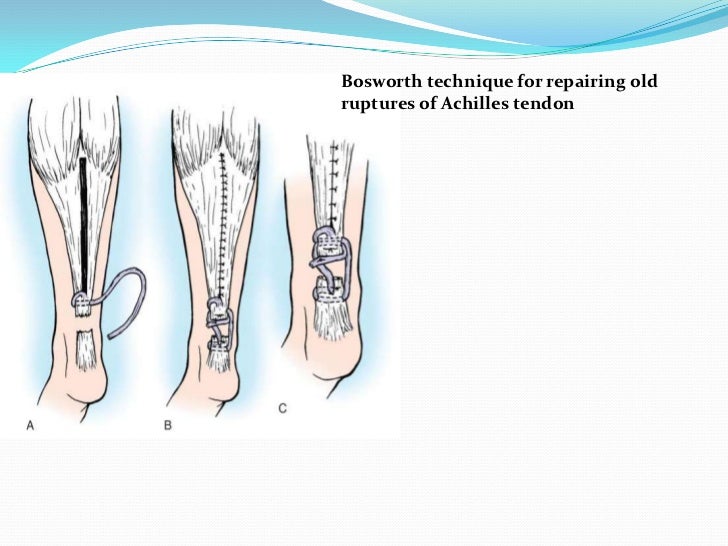Management of TendoAchillis rupture
