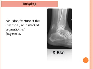 Ta Rupture Tendoachilles rupture and its management | PPTX