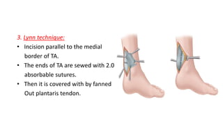 3. Lynn technique:
• Incision parallel to the medial
border of TA.
• The ends of TA are sewed with 2.0
absorbable sutures.
• Then it is covered with by fanned
Out plantaris tendon.
 