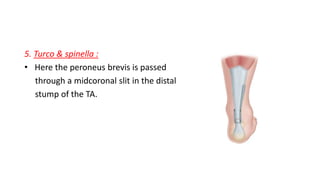 5. Turco & spinella :
• Here the peroneus brevis is passed
through a midcoronal slit in the distal
stump of the TA.
 