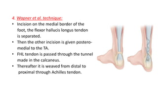 4. Wapner et al. technique:
• Incision on the medial border of the
foot, the flexor hallucis longus tendon
is separated.
• Then the other incision is given postero-
medial to the TA.
• FHL tendon is passed through the tunnel
made in the calcaneus.
• Thereafter it is weaved from distal to
proximal through Achilles tendon.
 