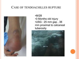 Ta Rupture TA Rupture - DR Chandramani Roy | PPTX